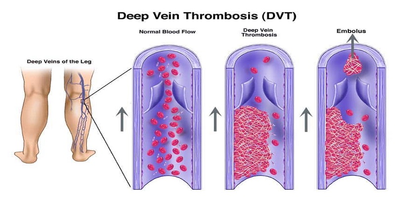 Chances of Venous Thrombosis in Covid-19 Patients - 98.4 Online